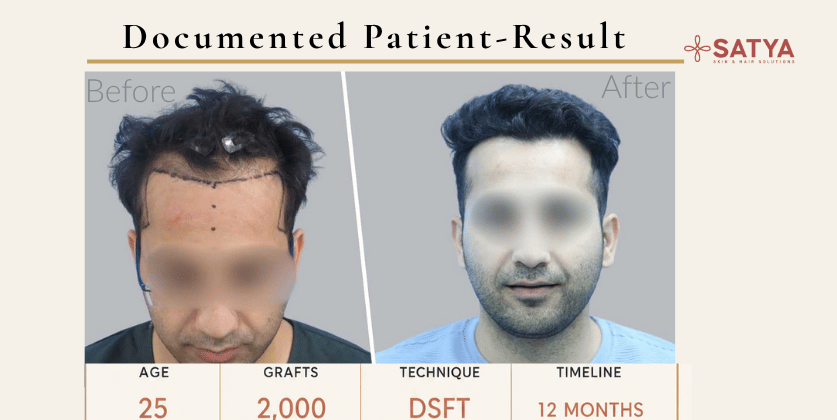Grade 1 Hairline Transplant Grade 1 Hairline Transplant
