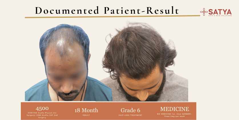 Hair TRansplant Result