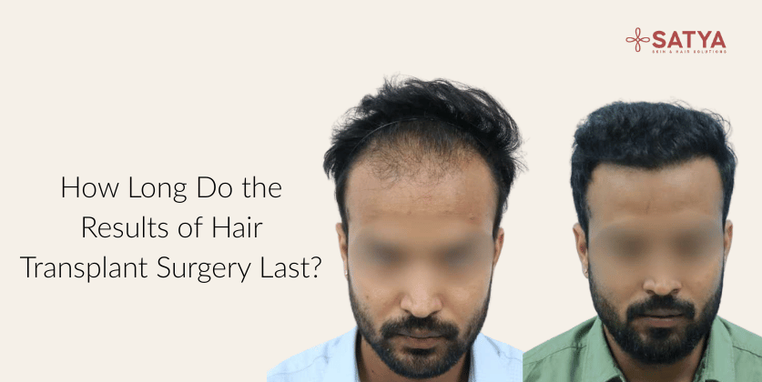 How Long Do the Results of Hair Transplant Surgery Last?